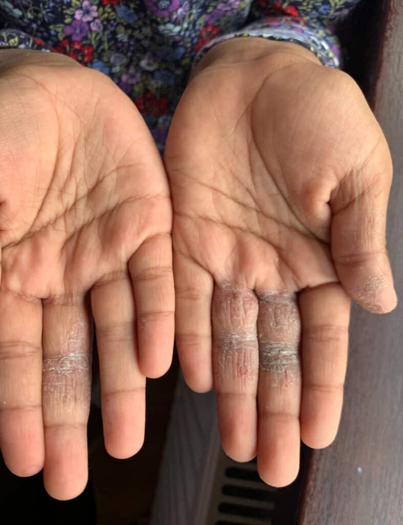 You can see Avneets hands which show how she suffers from eczema. 